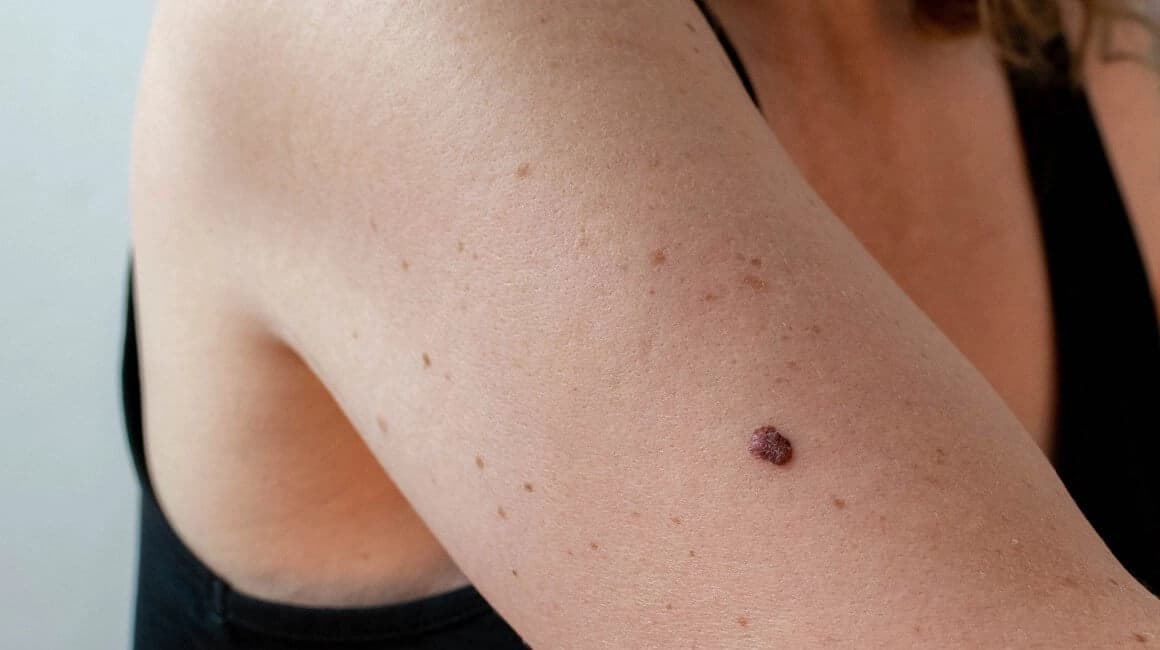 Maj u znaku borbe protiv melanoma, besplatni pregledi u UKC RS 29. maja