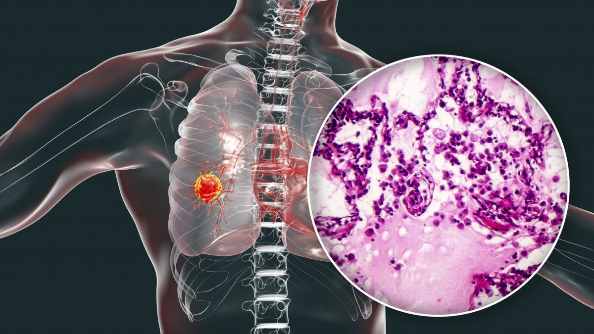 U Turskoj uočen neobičan oblik koronavirusa, ljekari mislili da se radi o raku pluća